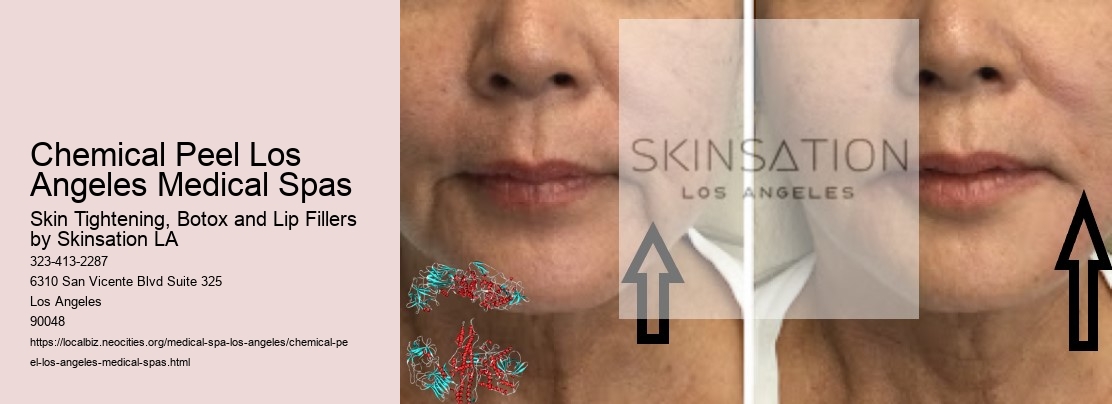 Chemical Peel Los Angeles Medical Spas